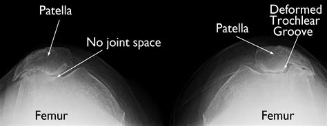 patellofemoral xrays.